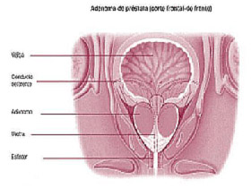 anedoma prostata