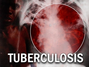 tuberculosisportada